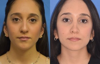 patient before and after rhinoplasty