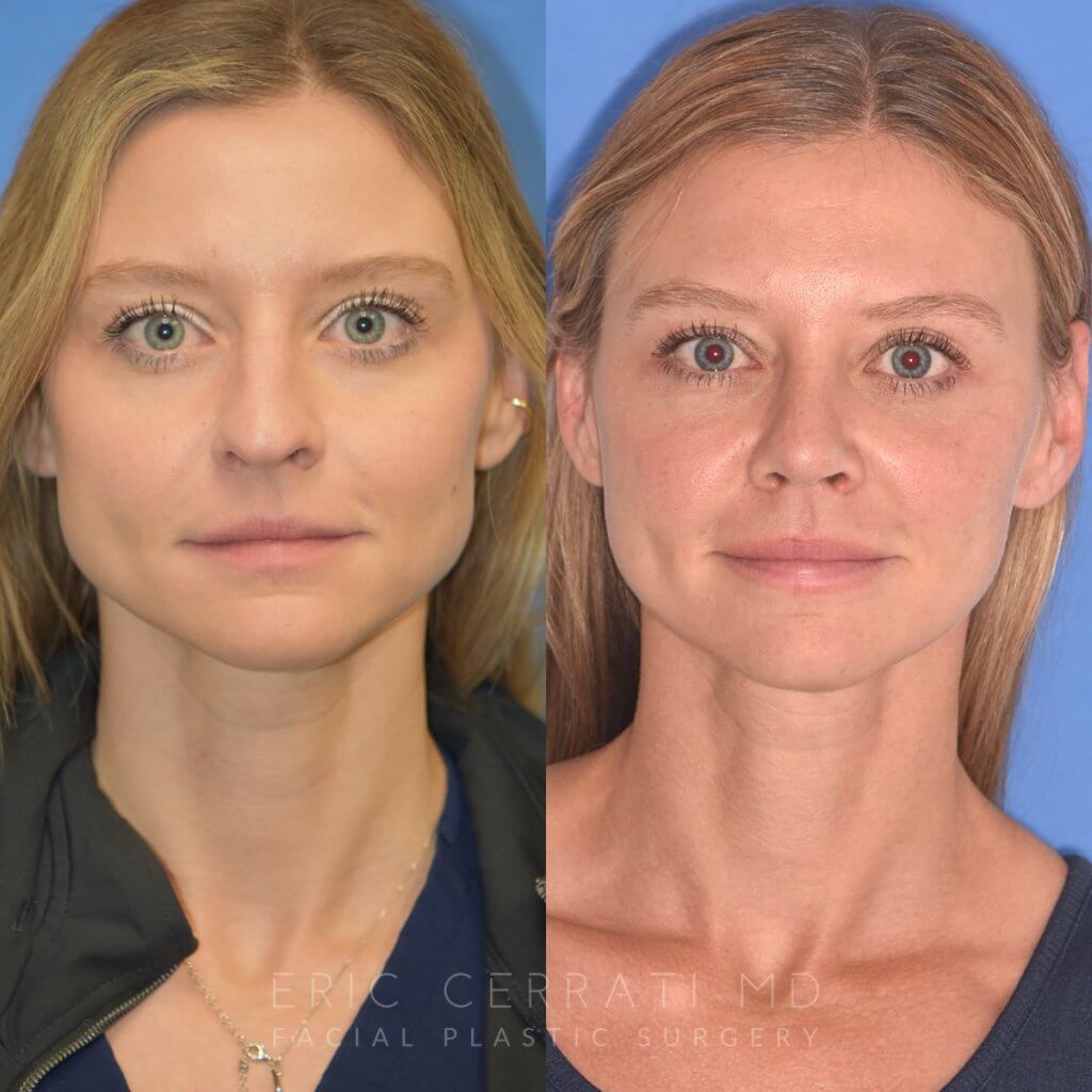Female patient before and after rhinoplasty