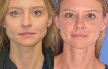 Female patient before and after rhinoplasty
