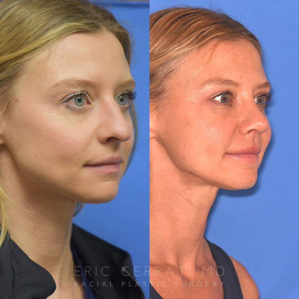 Female patient before and after rhinoplasty