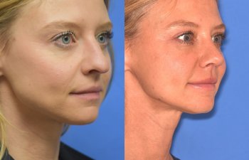 Female patient before and after rhinoplasty