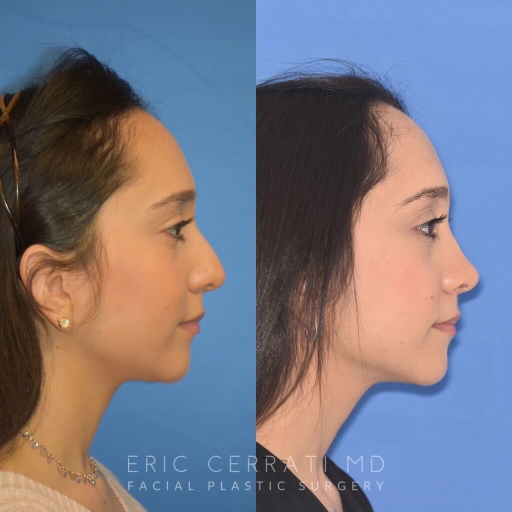 patient before and after rhinoplasty