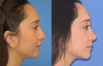 patient before and after rhinoplasty