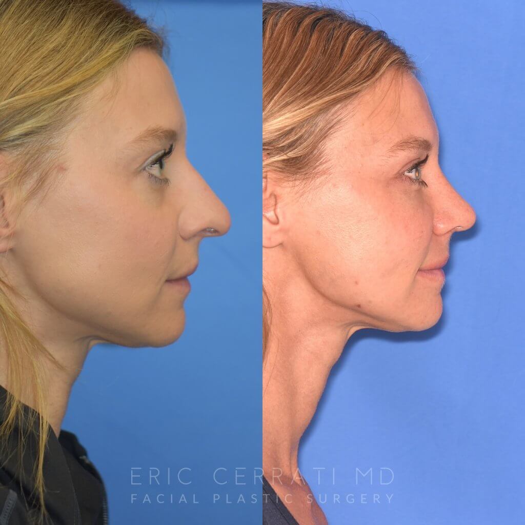 Female patient before and after rhinoplasty