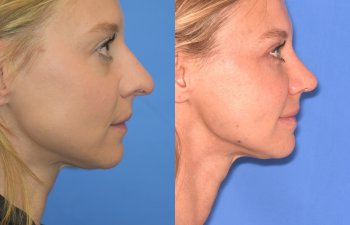 Female patient before and after rhinoplasty