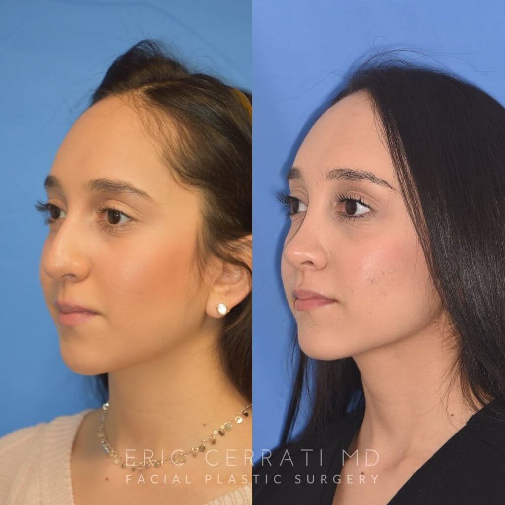 patient before and after rhinoplasty
