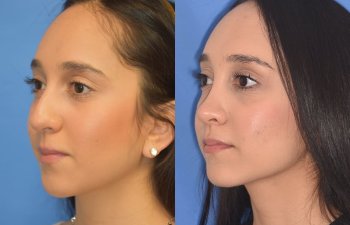 patient before and after rhinoplasty