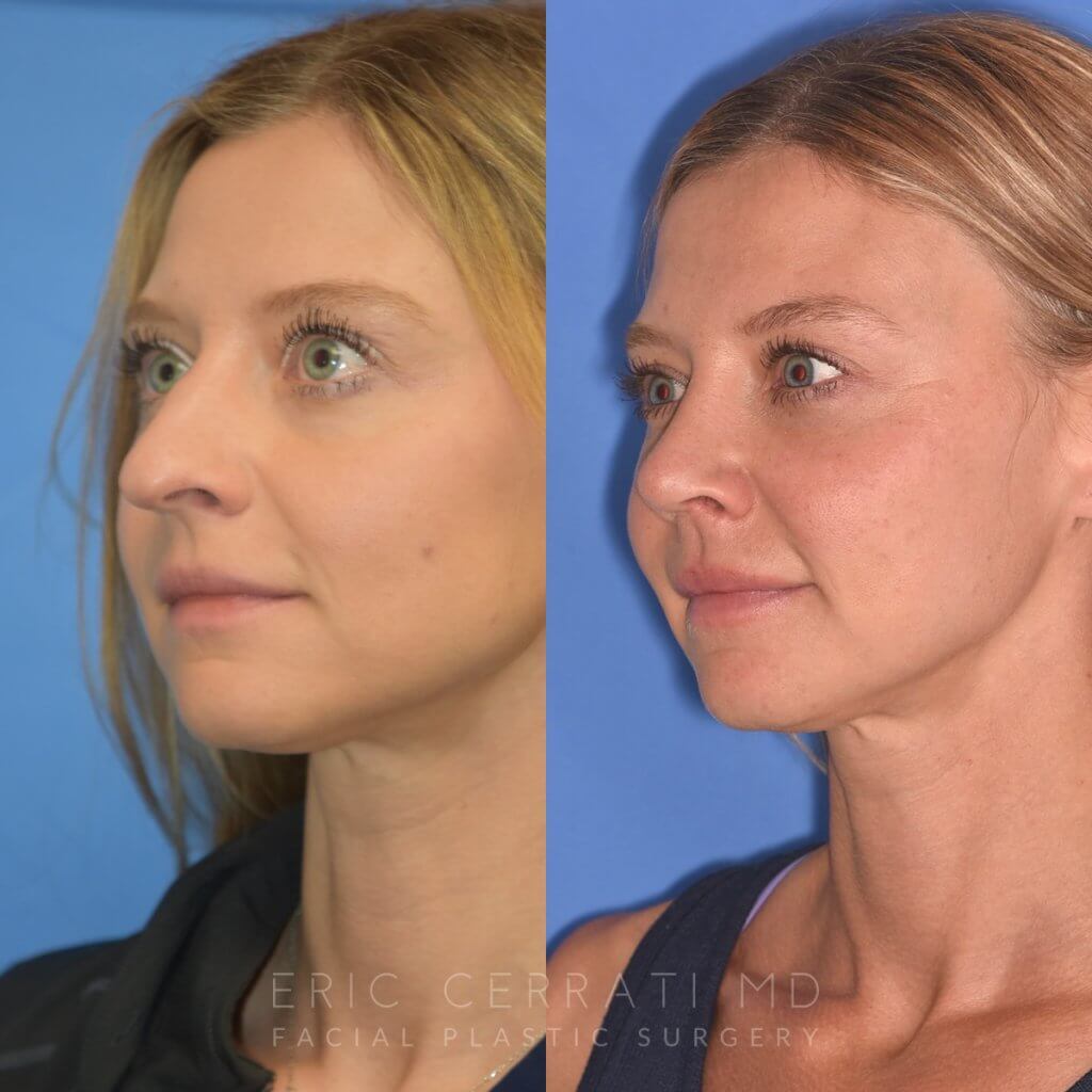 Female patient before and after rhinoplasty