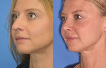 Female patient before and after rhinoplasty