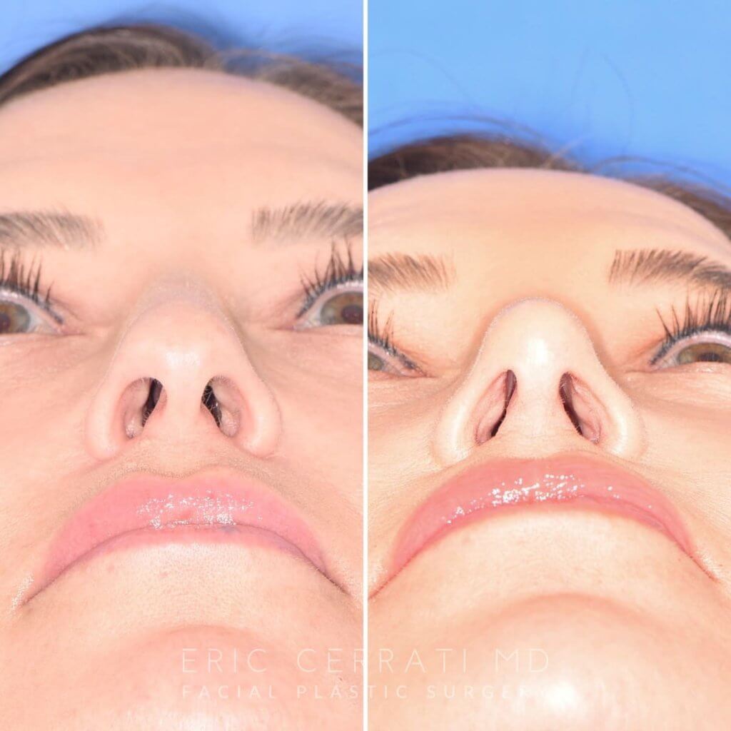 patient before and after facelift and rhinoplasty