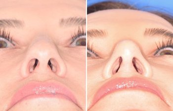 patient before and after facelift and rhinoplasty