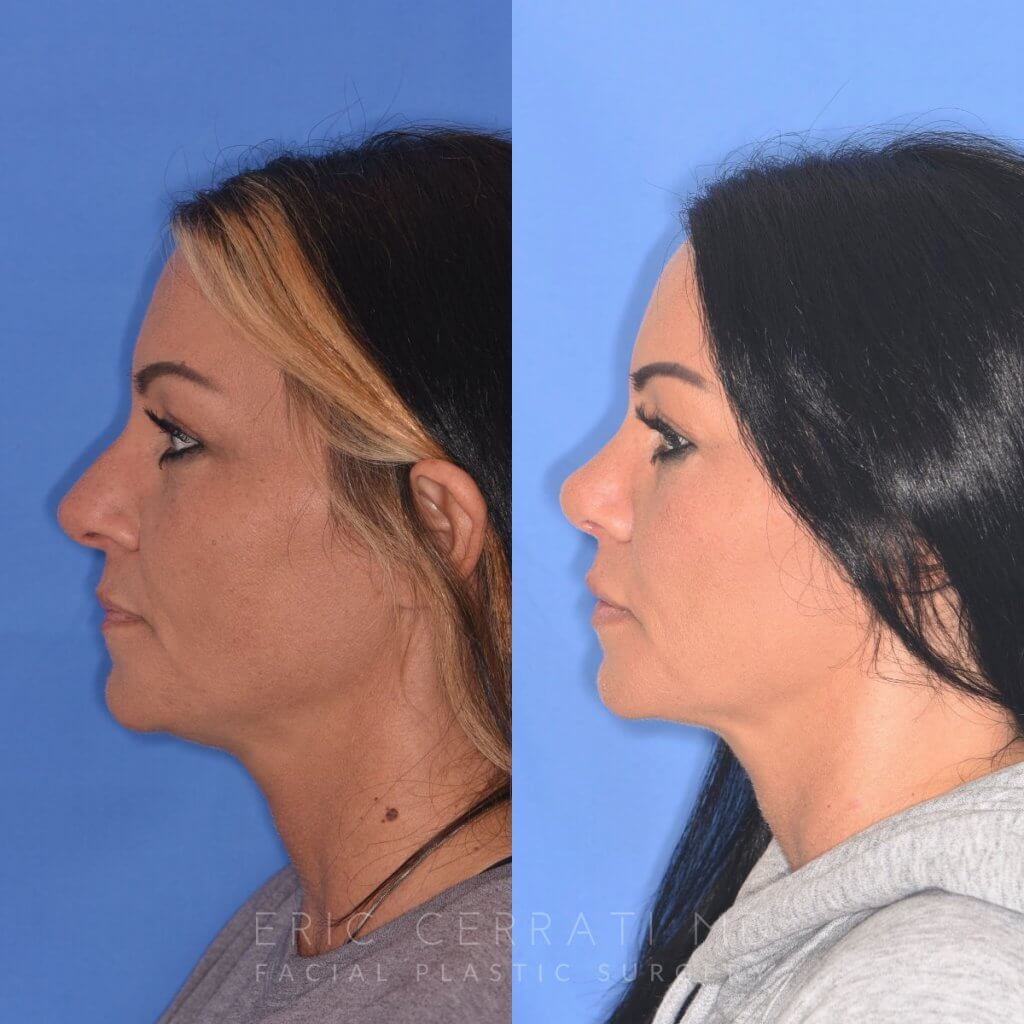 patient before and after rhinoplasty