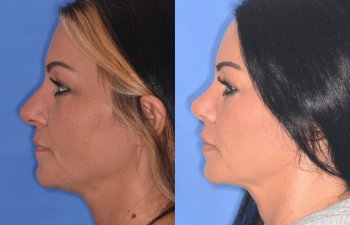patient before and after rhinoplasty