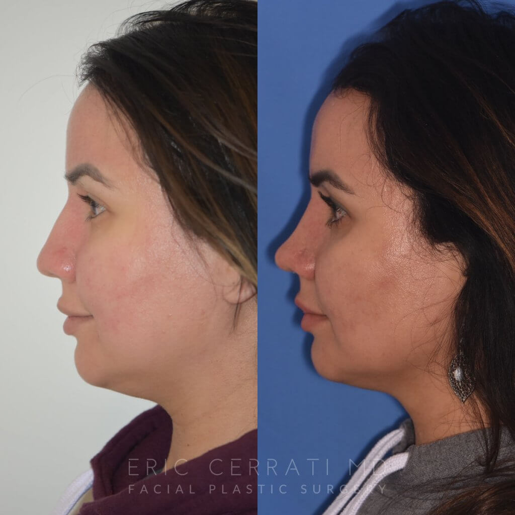 patient before and after rhinoplasty