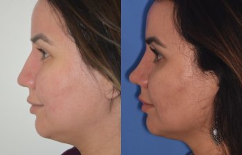 patient before and after rhinoplasty