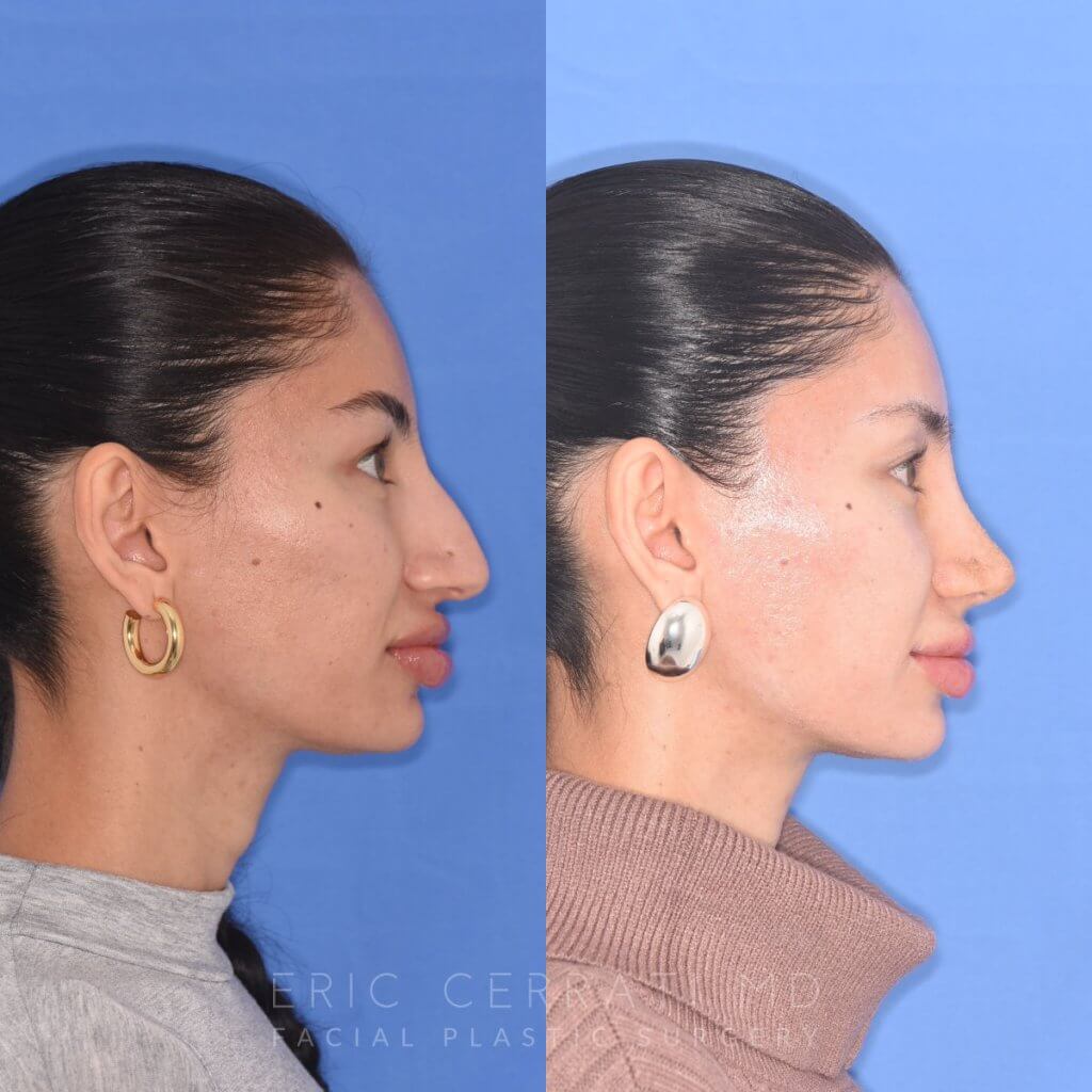patient before and after rhinoplasty