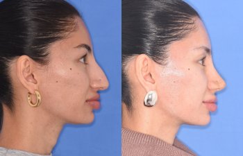 patient before and after rhinoplasty
