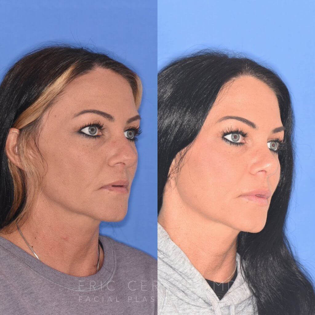 patient before and after rhinoplasty