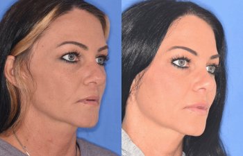 patient before and after rhinoplasty