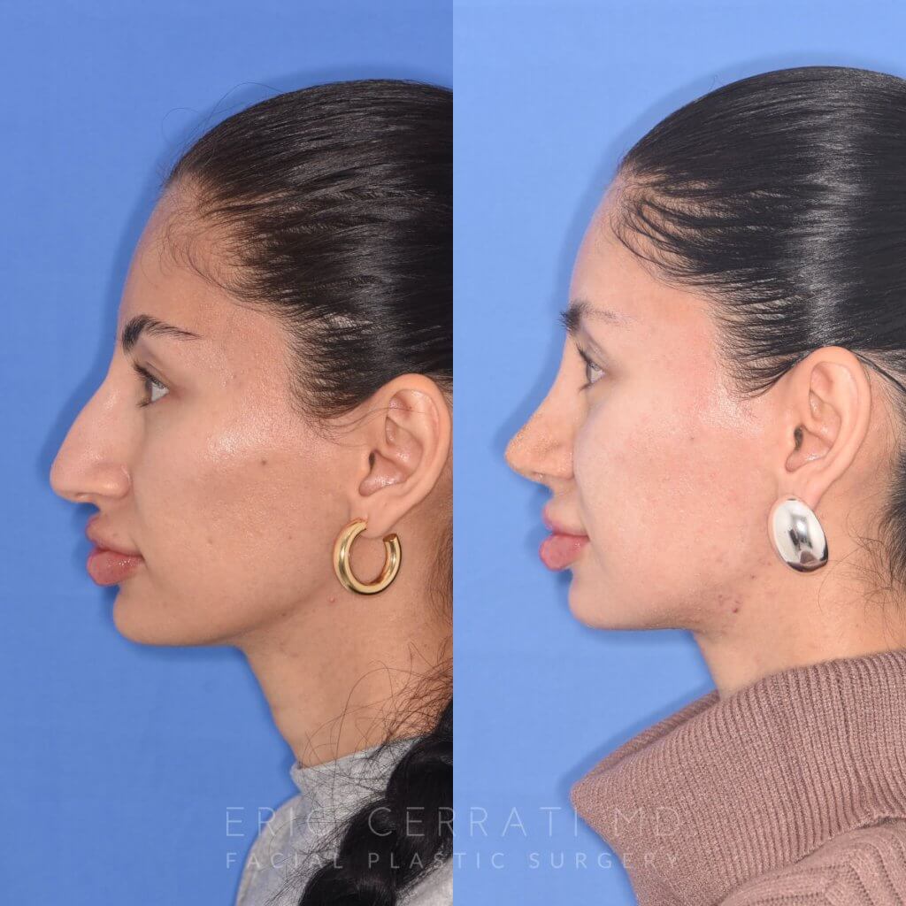 patient before and after rhinoplasty
