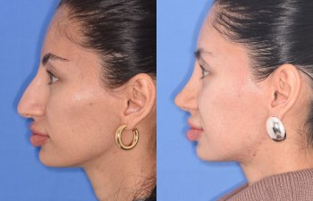 patient before and after rhinoplasty