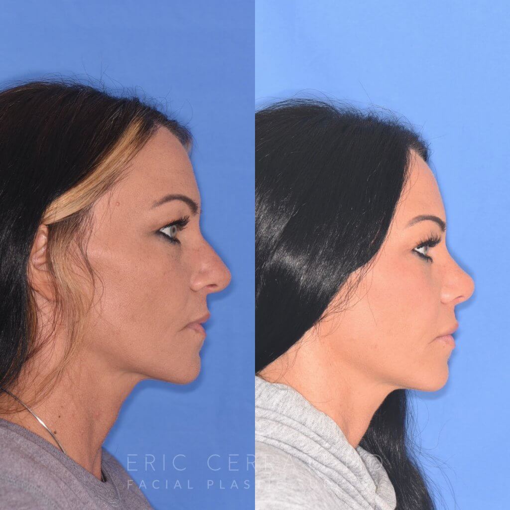 patient before and after rhinoplasty