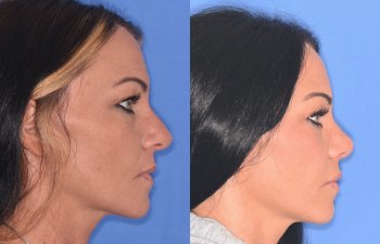 patient before and after rhinoplasty