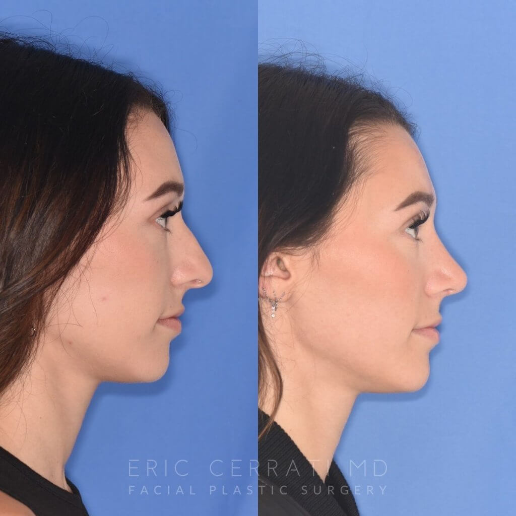 patient before and after rhinoplasty procedure