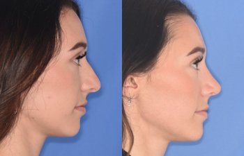 patient before and after rhinoplasty procedure