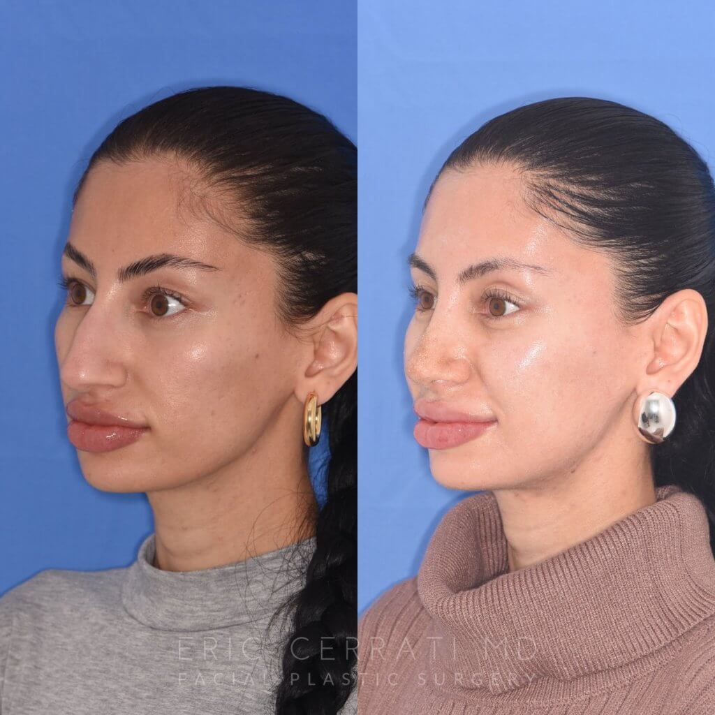 patient before and after rhinoplasty