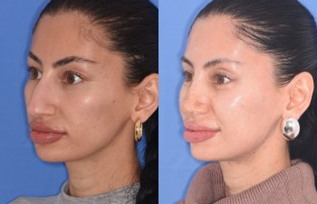 patient before and after rhinoplasty