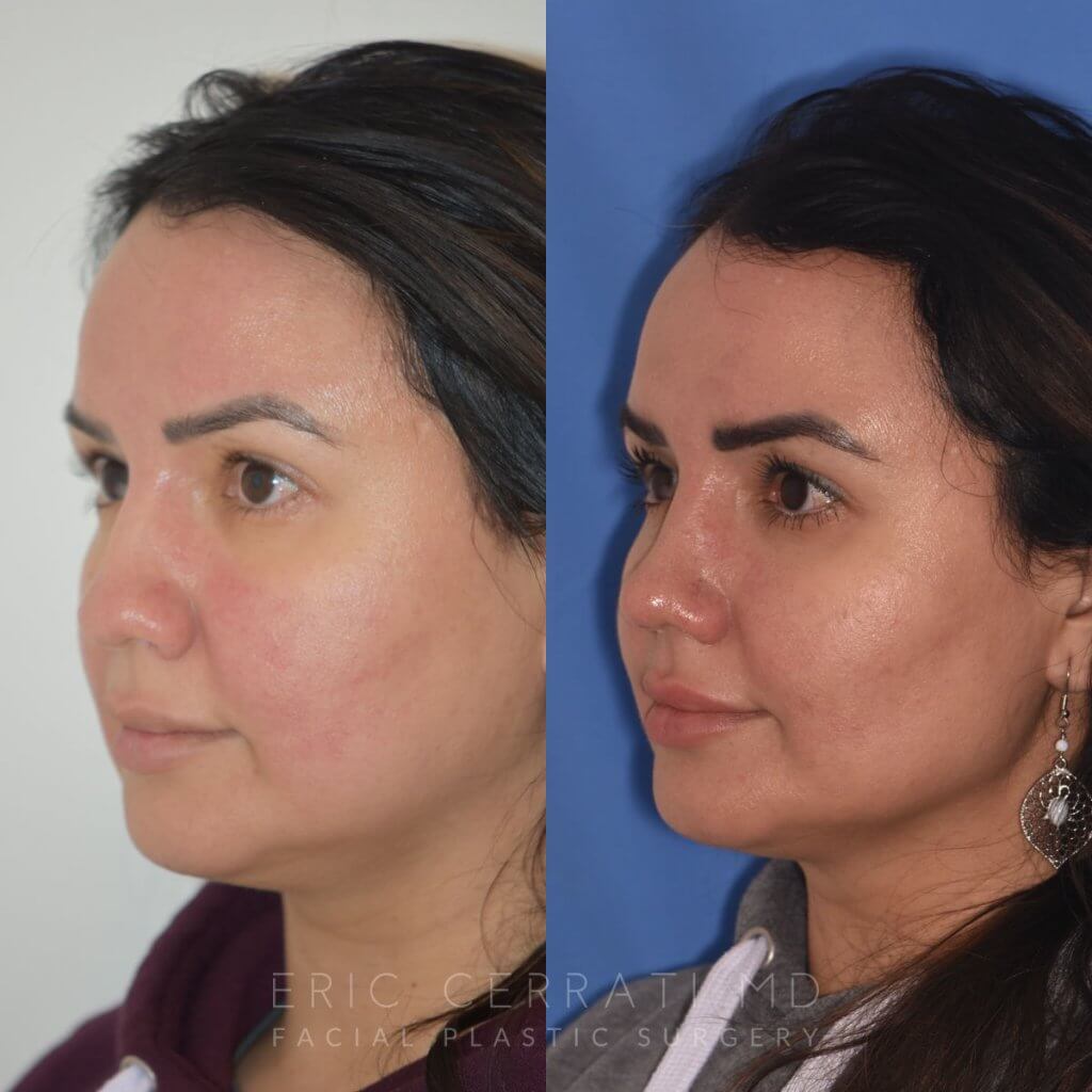 patient before and after rhinoplasty