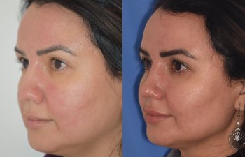 patient before and after rhinoplasty