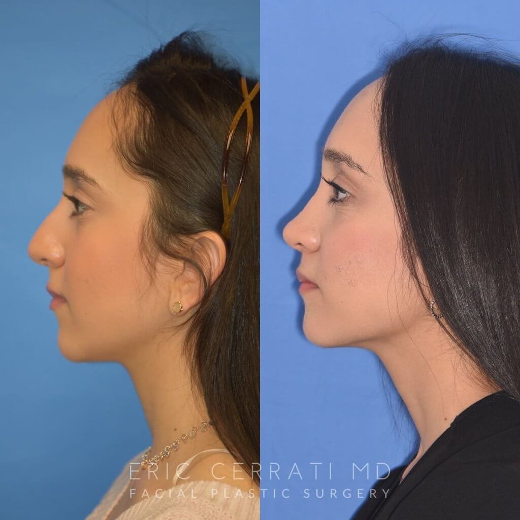 patient before and after rhinoplasty