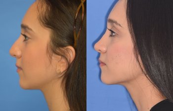 patient before and after rhinoplasty