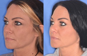 patient before and after rhinoplasty