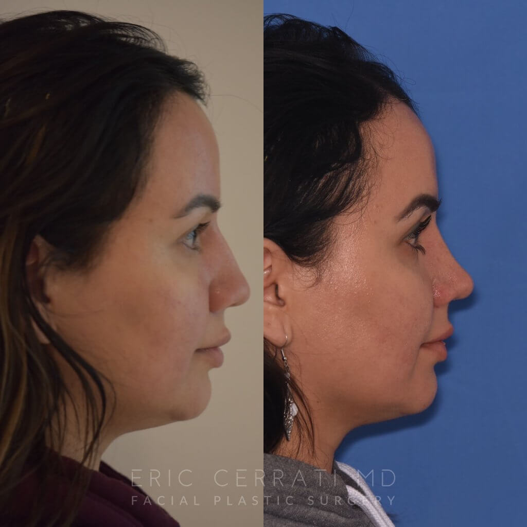 patient before and after rhinoplasty