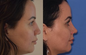 patient before and after rhinoplasty