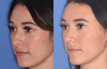 patient before and after rhinoplasty procedure