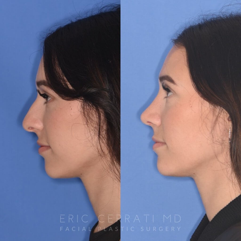 patient before and after rhinoplasty procedure