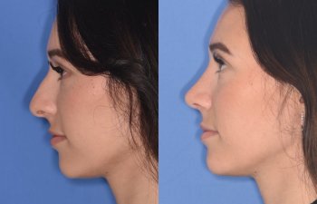 patient before and after rhinoplasty procedure