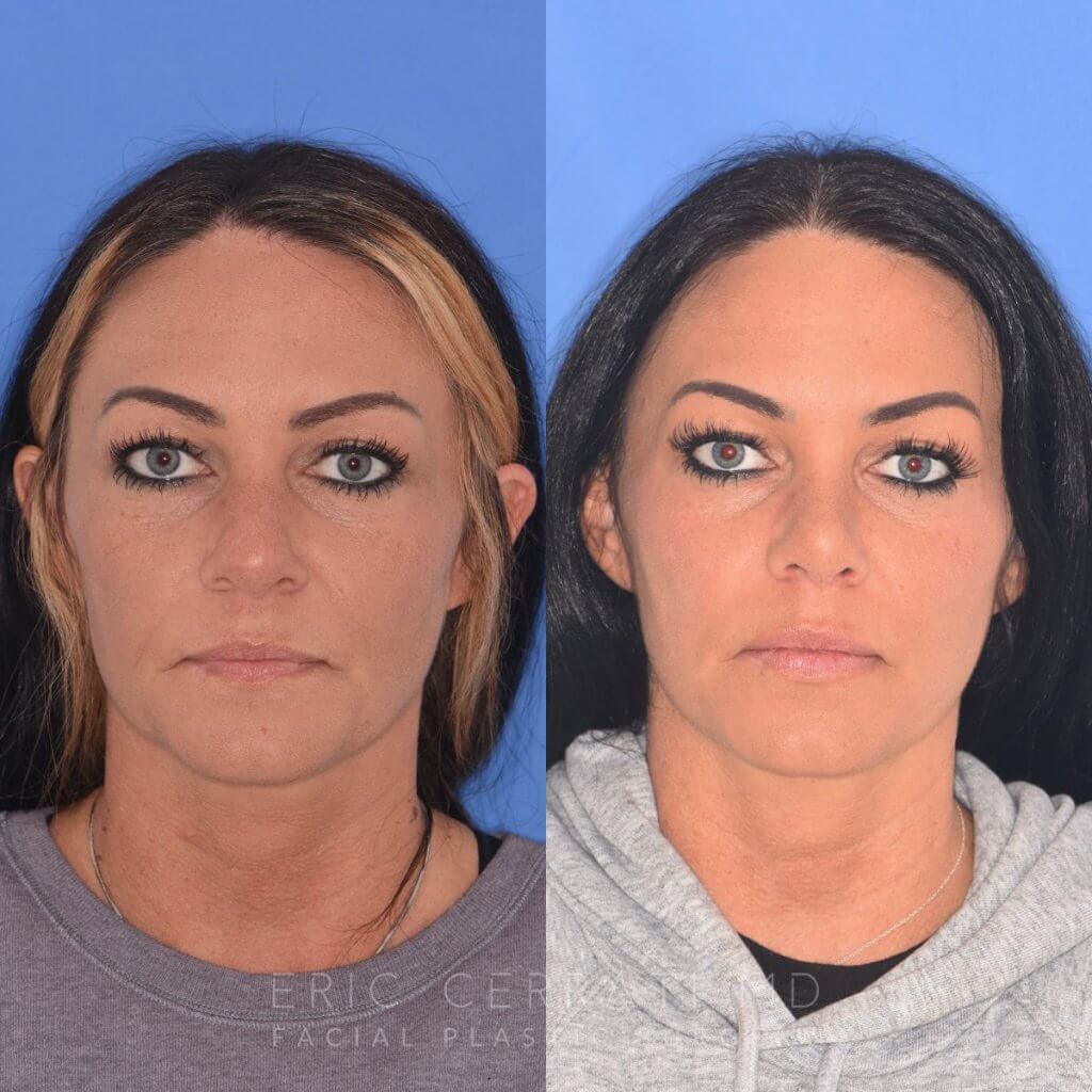 patient before and after rhinoplasty