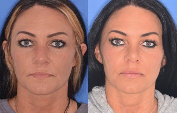 patient before and after rhinoplasty