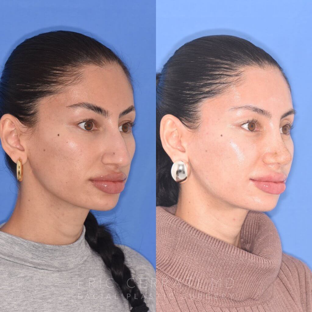 patient before and after rhinoplasty