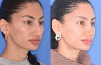 patient before and after rhinoplasty