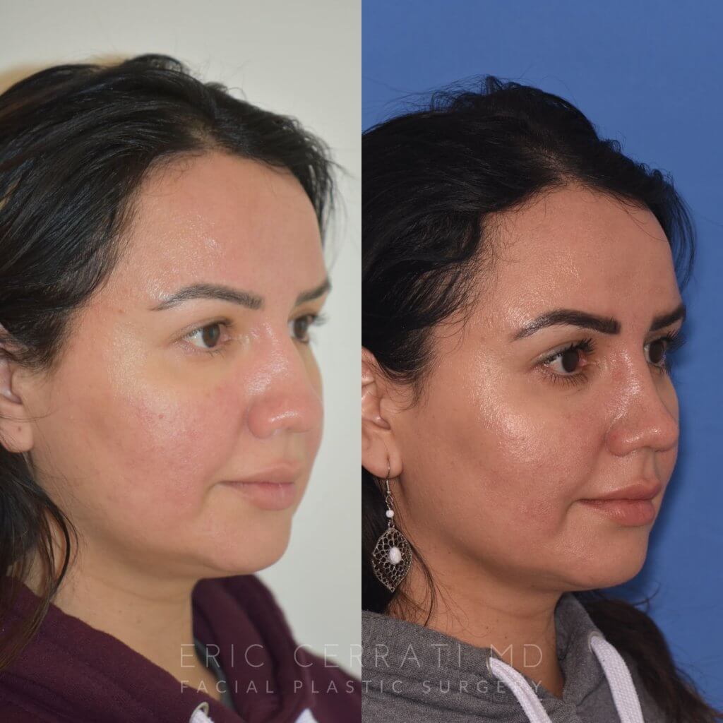patient before and after rhinoplasty