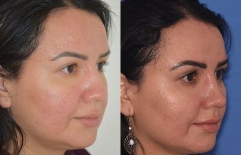 patient before and after rhinoplasty