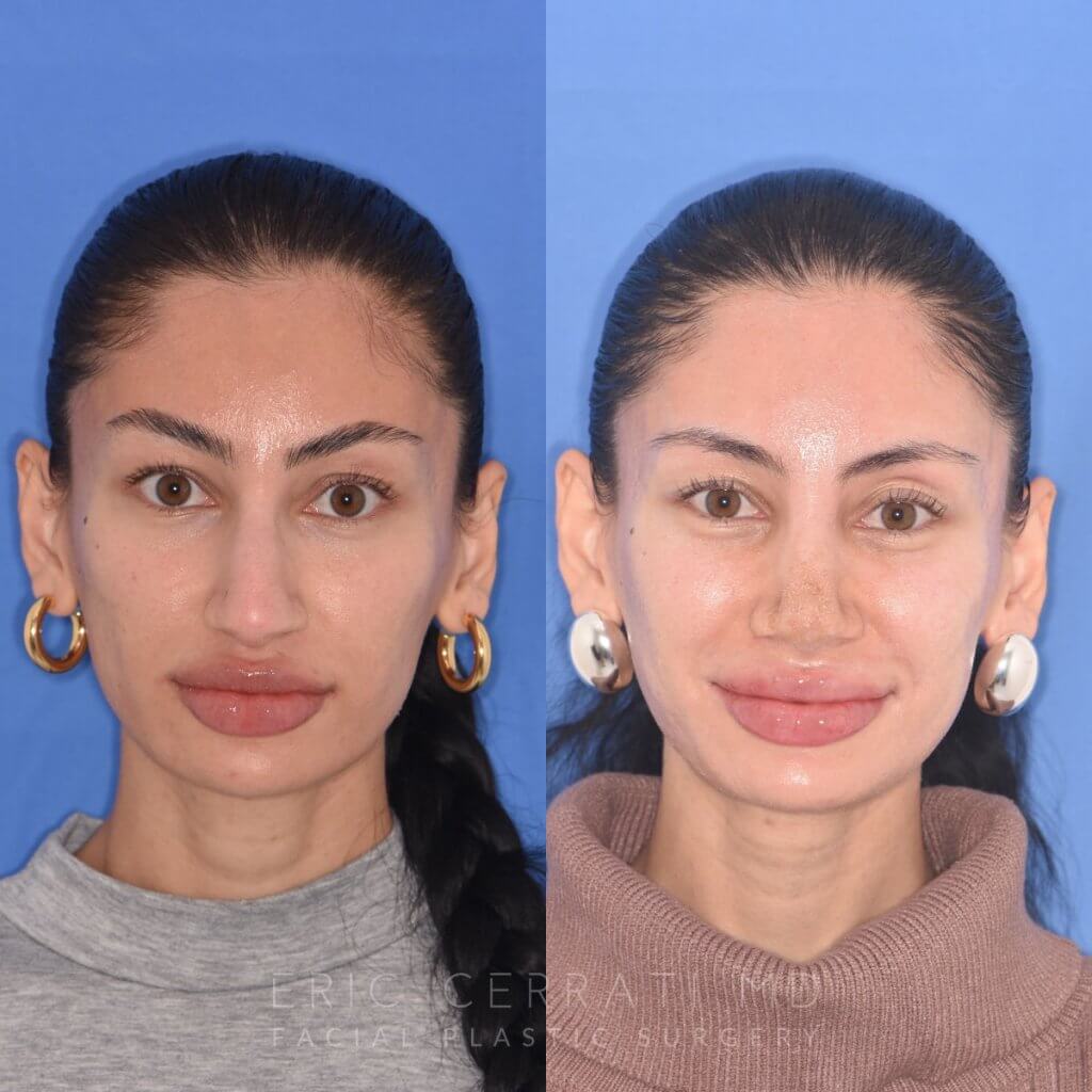 patient before and after rhinoplasty