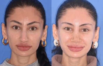 patient before and after rhinoplasty