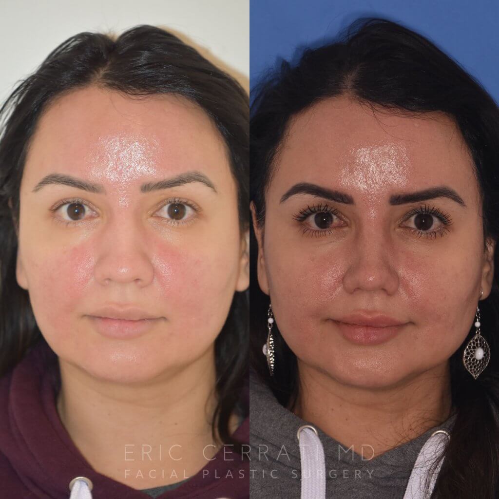 patient before and after rhinoplasty